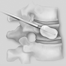 Balloon Kyphoplasty