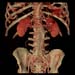 angio abd stent