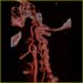 neuro carotid