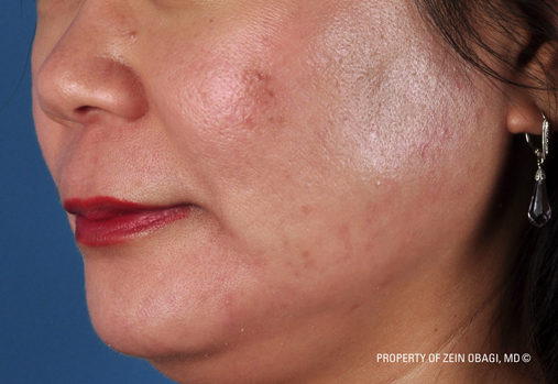 After-ZO Severe Acne System