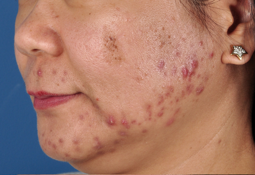 Before-ZO Severe Acne System