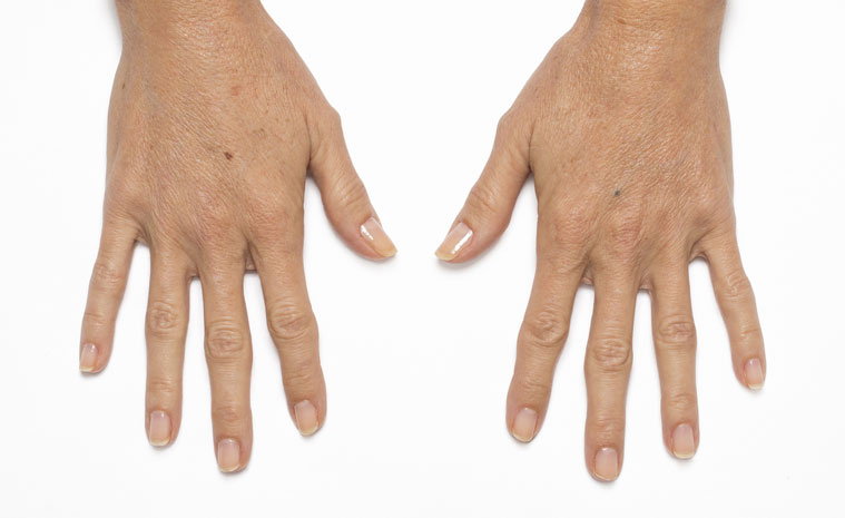 After-Hand Rejuvination with Dermal Fillers