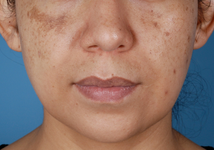 Before-Hydroquinone System